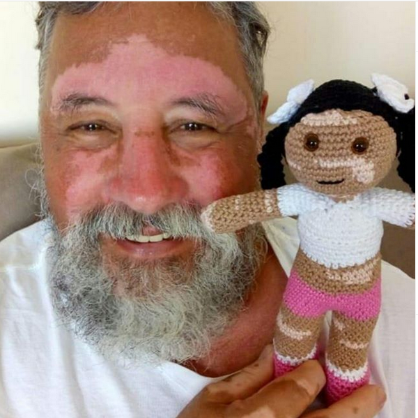 vitiligo-abuelo.png
